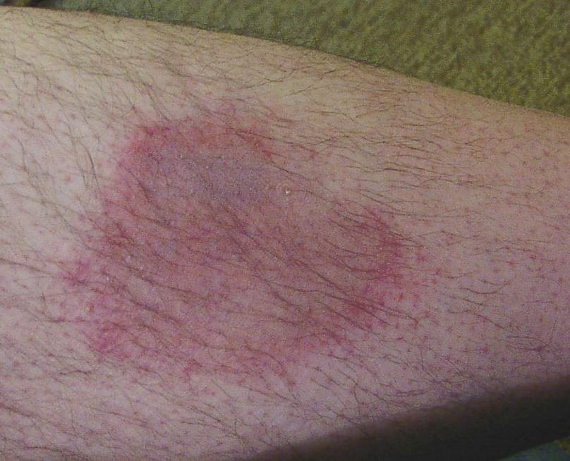 erythema-motilans.jpg